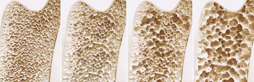 Cuatro etapas que muestran como un hueso humano va perdiendo densidad ósea hasta llegar a la osteoporosis