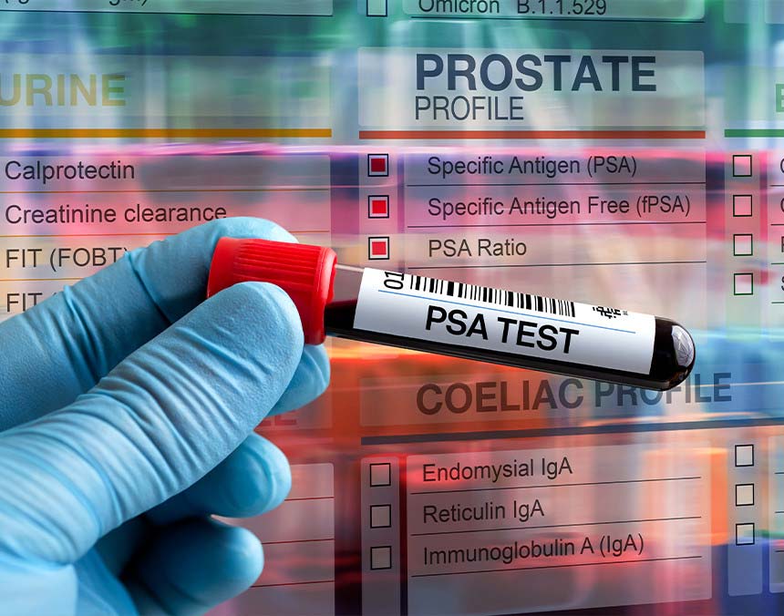 Mano de un médico con un guante azul, sosteniendo un tubo de recolección de sangre que tiene una etiqueta de la prueba de antígeno prostático