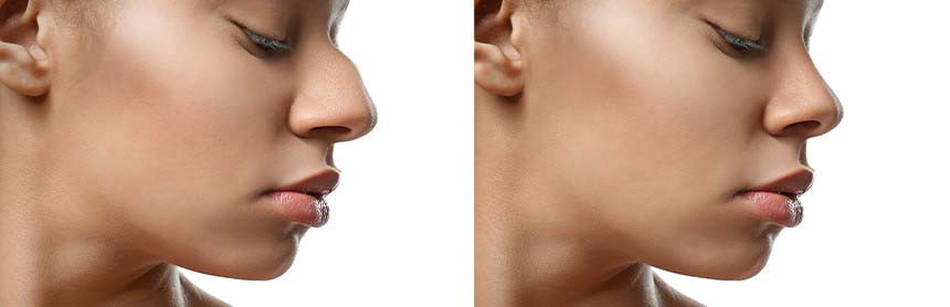 Dos imágenes, la primera muestra a la paciente con el tabique de la nariz desviado y en la segunda ya corregido