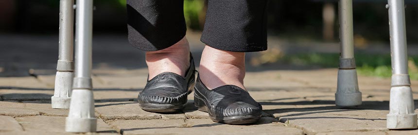 Pies de un paciente con zapatos negros y con retención de líquidos, caminando con una andadera gris