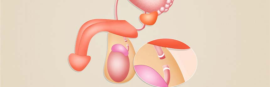 Imagen gráfica del sistema reproductor masculino después de haberse realizado una vasectomía