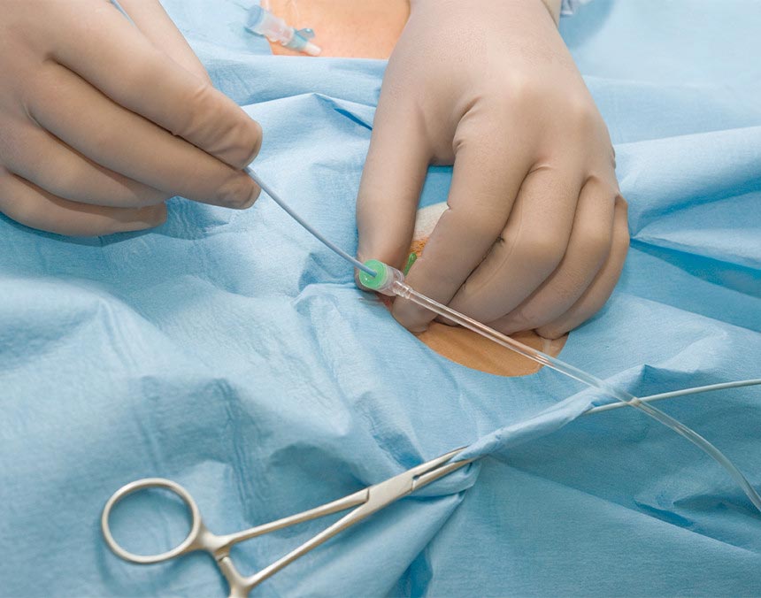 Manos de un médico introduciendo un catéter en un paciente que se encuentra tapado con una bata azul