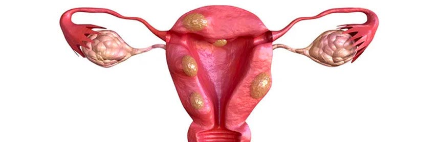 Imagen gráfica de un útero de color rosa con miomas uterinos de color café