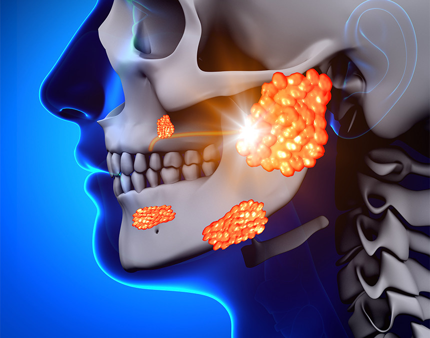 Imagen gráfica de un cráneo humano con parotiditis, resaltándolo con manchas naranjas en la mandíbula