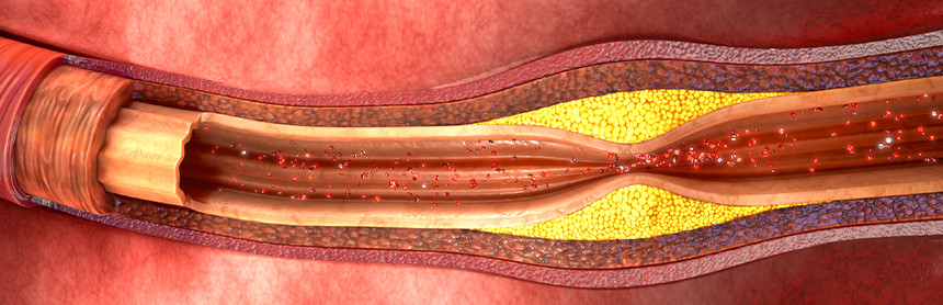 Imagen gráfica de una arteria siendo obstruida por el exceso de colesterol malo