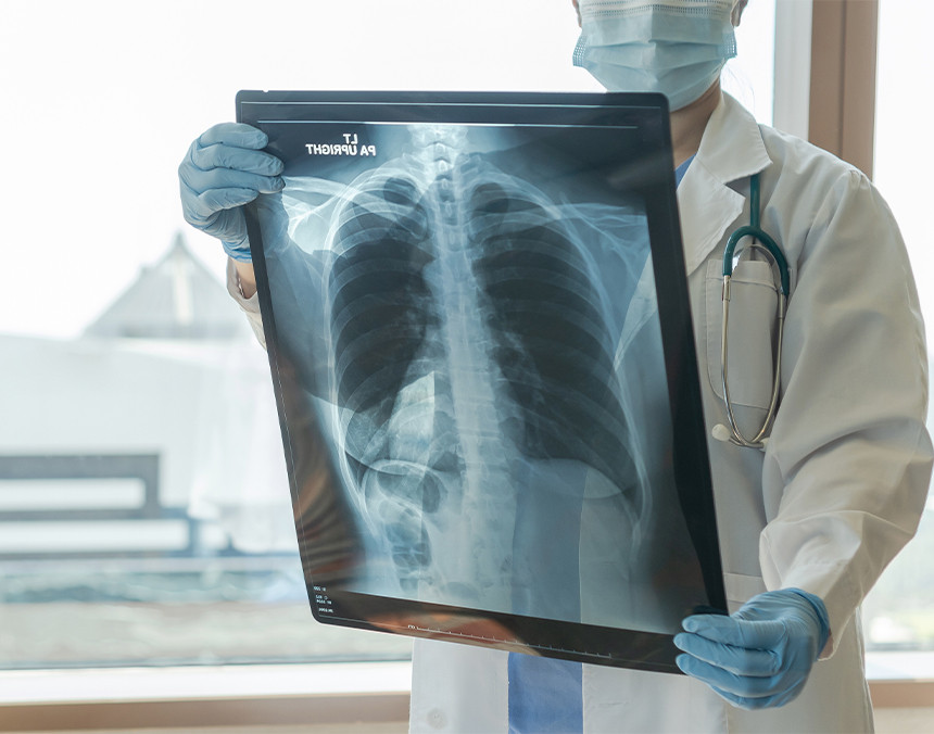 Médico con bata blanca y guantes azules sosteniendo una radiografía de tórax