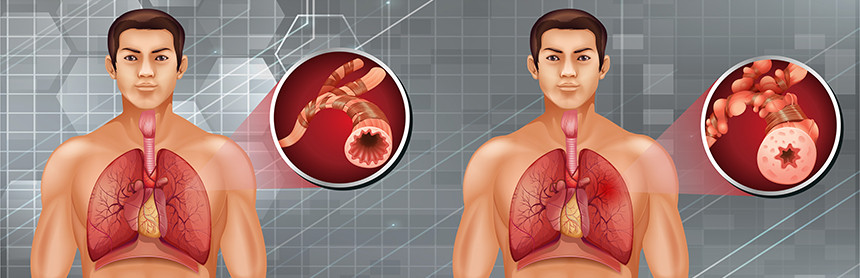 Diagrama de una persona con el pulmón sano y otra persona con el pulmón mal debido a la enfermedad pulmonar obstructiva crónica