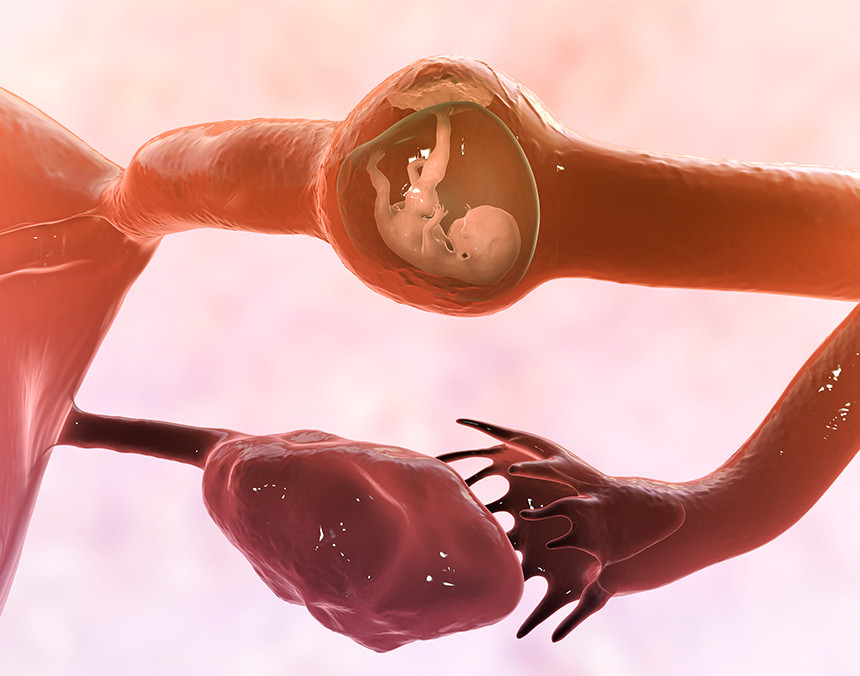 Embarazo ectópico: ¿cómo reconocerlo?