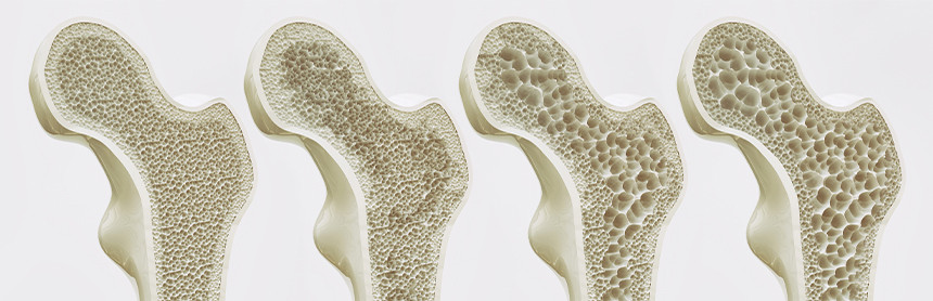 Ilustración 3D de cuatro huesos donde se ve el progreso de la osteoporosis