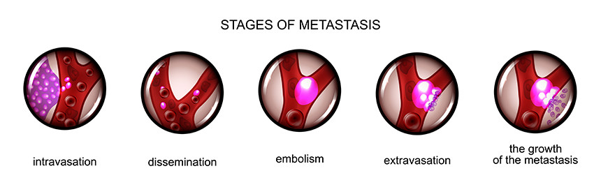 Fases del proceso de desarrollo de una célula cancerosa rosa hasta convertirse en metástasis