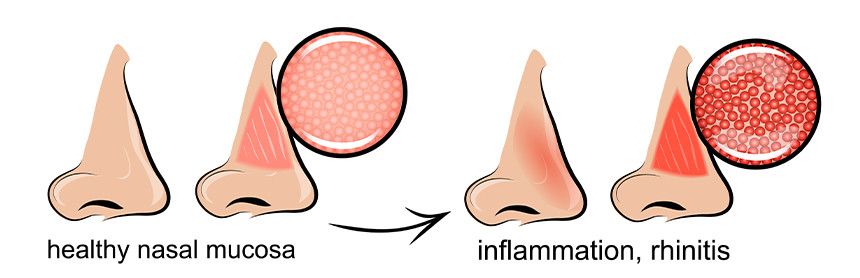 Ilustración de una nariz sana y otra que presenta inflamación de la mucosa nasal