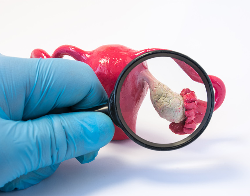 Mano de un médico con guante azul, sosteniendo una lupa y buscando anomalías en un prototipo de un ovario