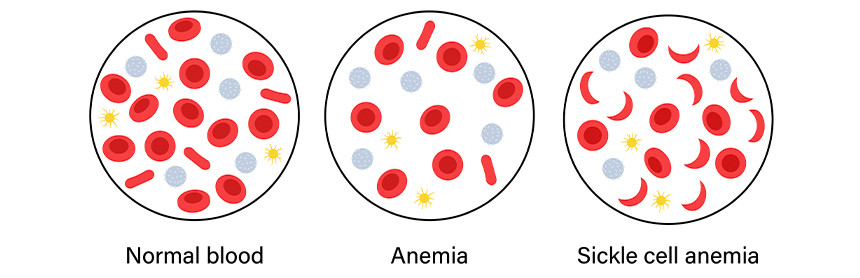 Ilustración de tres círculos, en el primero están los componentes normales de la sangre normal. En el segundo muestra anemia