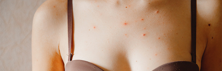 Primer plano del pecho de una mujer que padece herpes con sarpullido