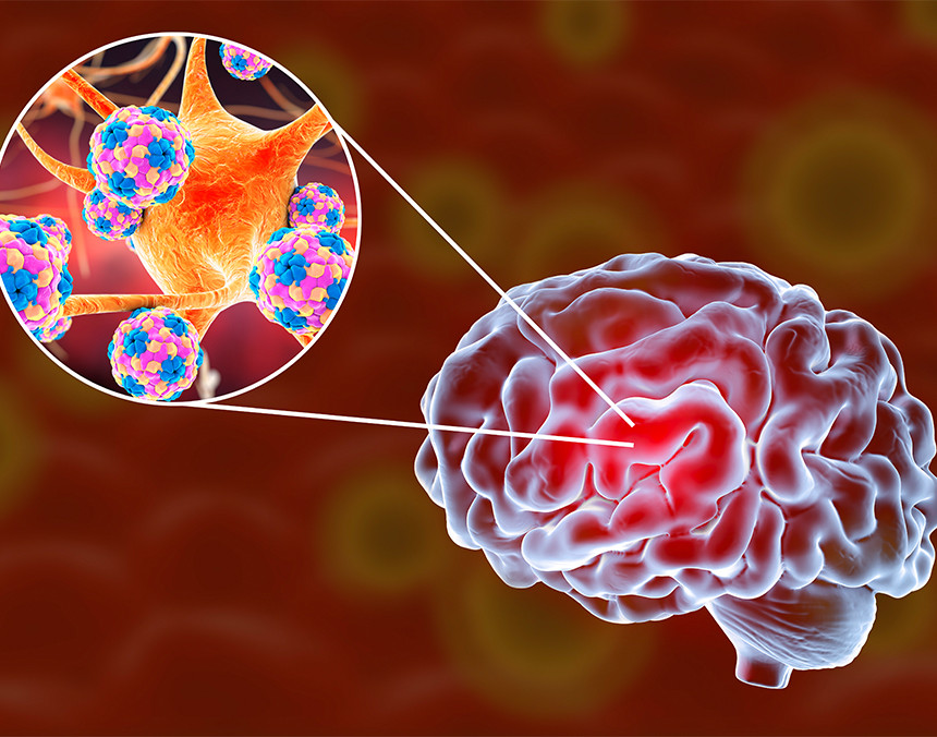 Ilustración de un cerebro humano en color azul y denotando con rojo la enfermedad encefalitis