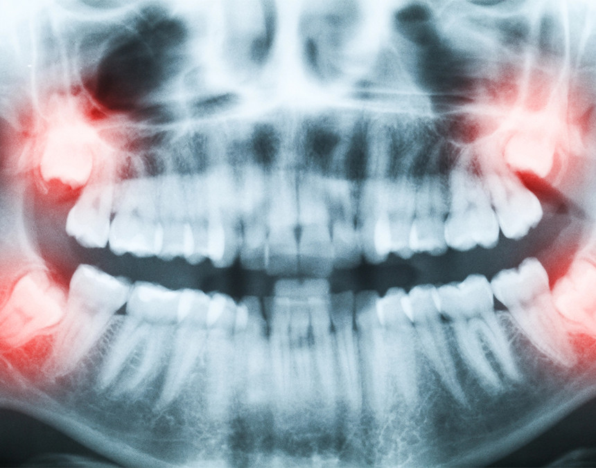 Primer plano de una radiografía de una mandíbula, denotando son rojo las muelas del juicio