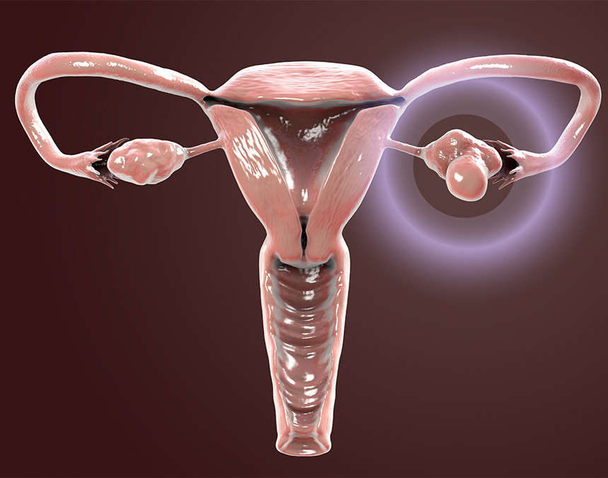 ¿Cuáles son las causas del ovario poliquístico?