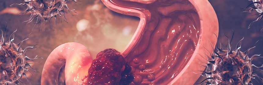 Ilustración 3D de estómago de color rosa siendo invadido por una célula cancerosa de color rojo