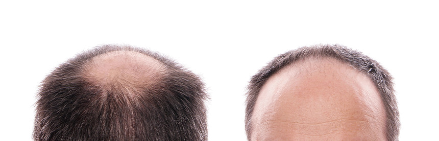 Dos cabezas de un hombre con alopecia, mostrado pérdida de cabello en la parte posterior y frontal de la cabeza