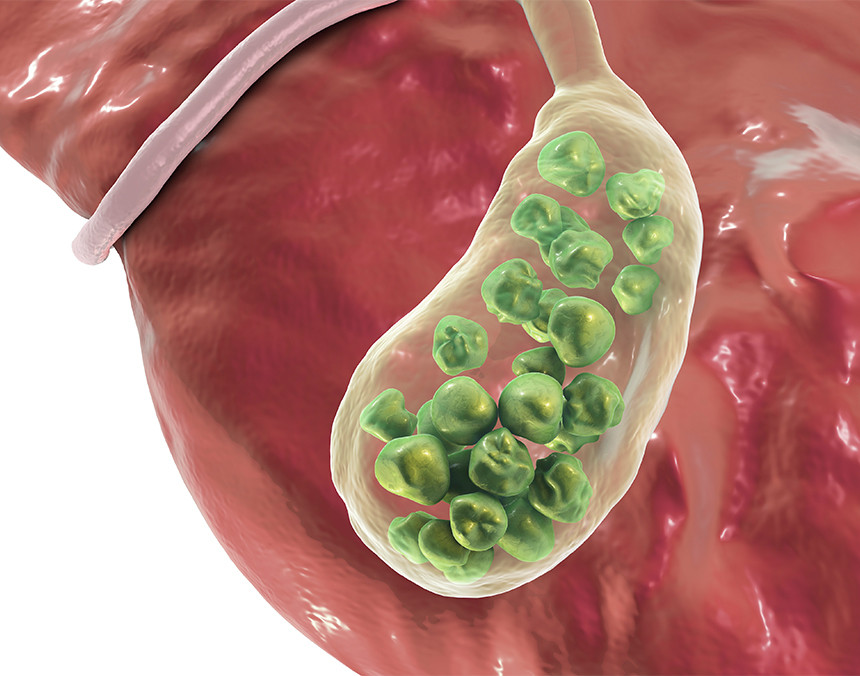 Ilustración de la parte inferior del hígado y la vesícula biliar en color verde con muchos cálculos biliares