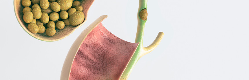 Ilustración de la vesícula biliar de color verde con muchos cálculos biliares pasando al conducto biliar d color rosa