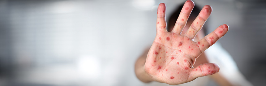 Mano de un hombre con muchas manchas rojas a causa de la varicela