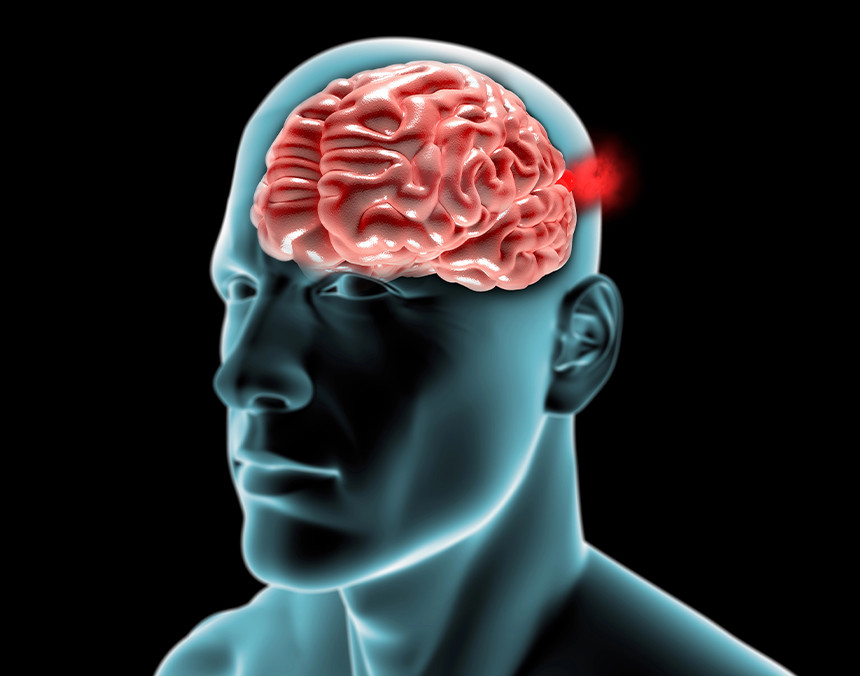 Ilustración de una radiografía de una cabeza humana con con aneurisma cerebral