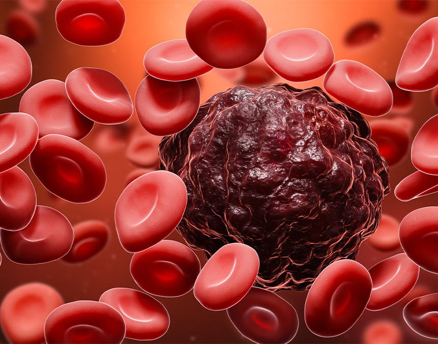 Célula cancerosa de color marrón rodeada de glóbulos rojos en un torrente sanguíneo