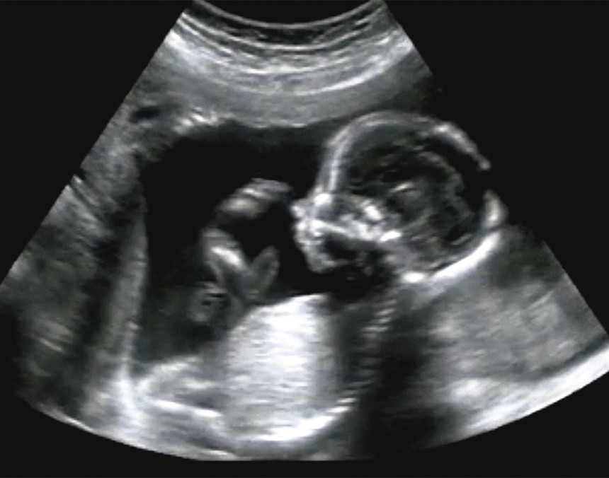 Ecografía obstétrica de un feto de cuatro meses