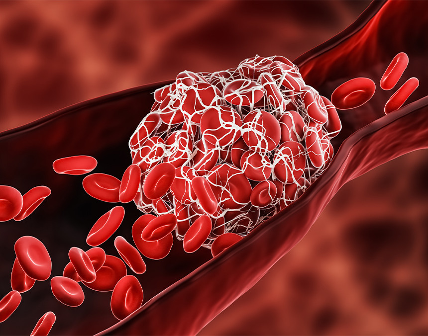 Trombo sanguíneo que bloquea el flujo de los glóbulos rojos dentro de una vena de color rojo