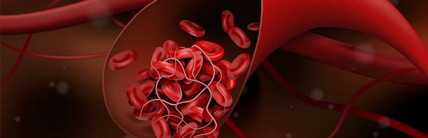 Coágulo de sangre de color rojo obstruyendo el flujo de los glóbulos rojos dentro de un torrente sanguíneo