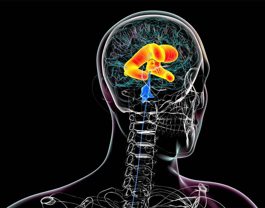 Ilustración 3D del cerebro humano con hidrocefalia con un fondo de color negro