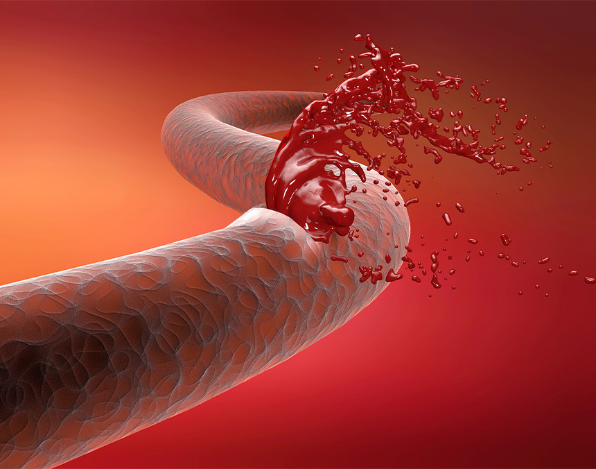 Ilustraciñon 3D de una hemorragia en un torrente sanguíneo