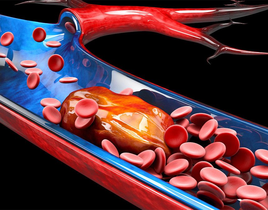 Ilustración 3D de trombosis venosa profunda. Los coágulos de sangre son de color rojo y el torrente sanguíneo azul