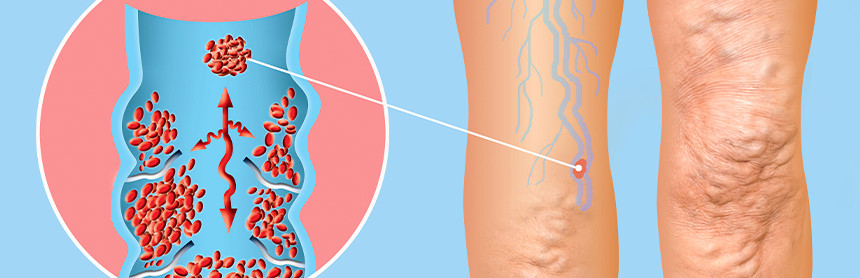 Ilustración de dos piernas de una mujer con trombosis venosa profunda