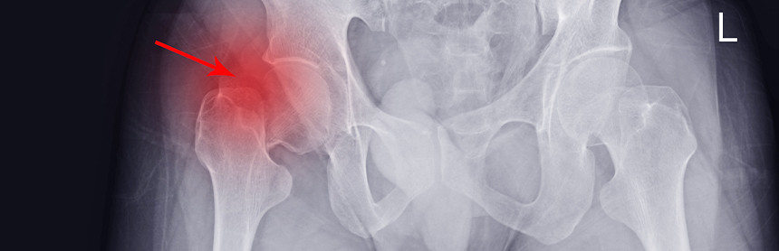 Radiografía de cadera con un fractura resaltada con una mancha de color rojo