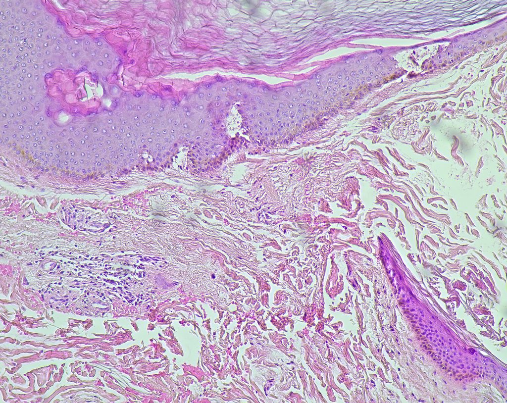 Muestra de biopsia para análisis de un padecimiento.