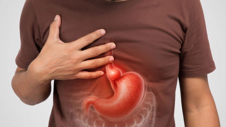 Hernia hiatal: síntomas, tipos y tratamiento