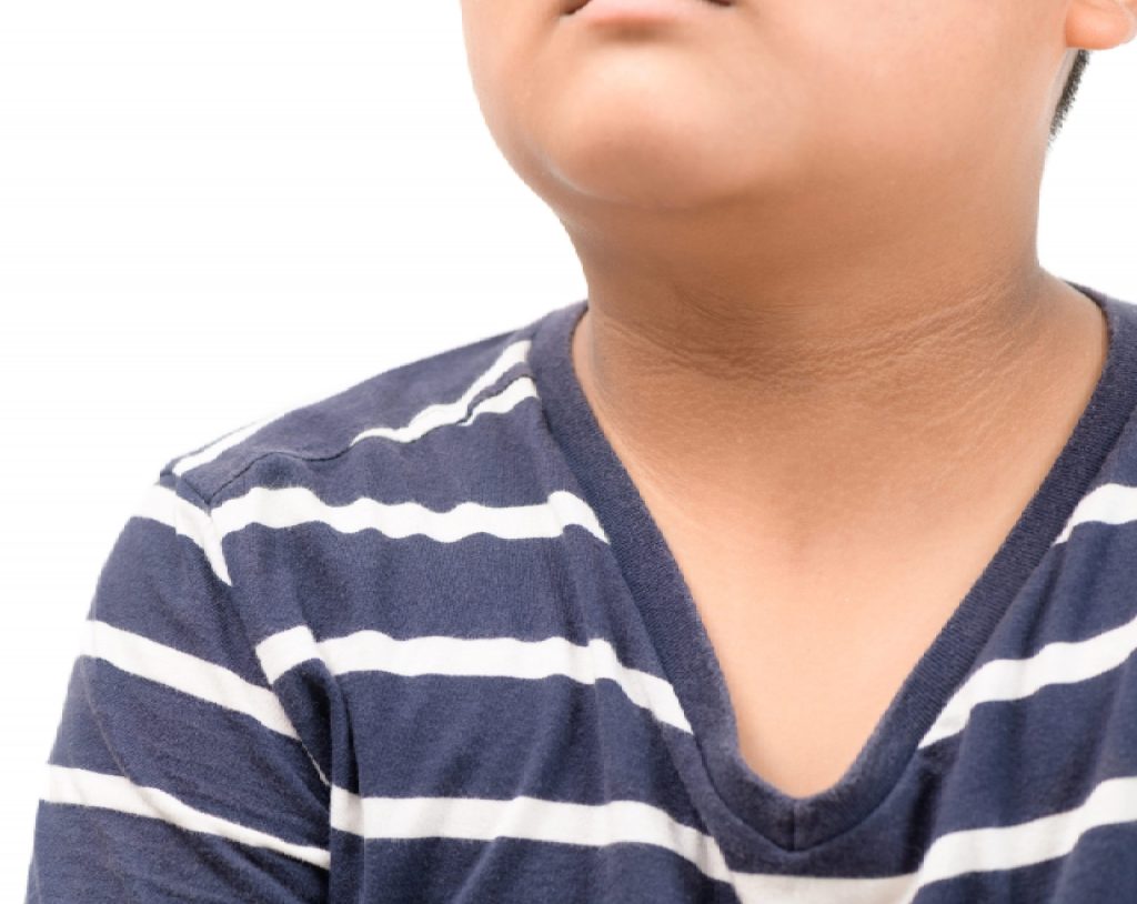 Joven con sobrepeso que presenta acantosis nigricans, manchas oscuras en la piel propias de la prediabetes y diabetes.