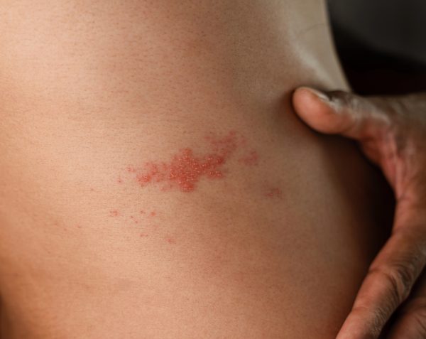 Herpes zóster: síntomas, tratamiento y cómo prevenirlo