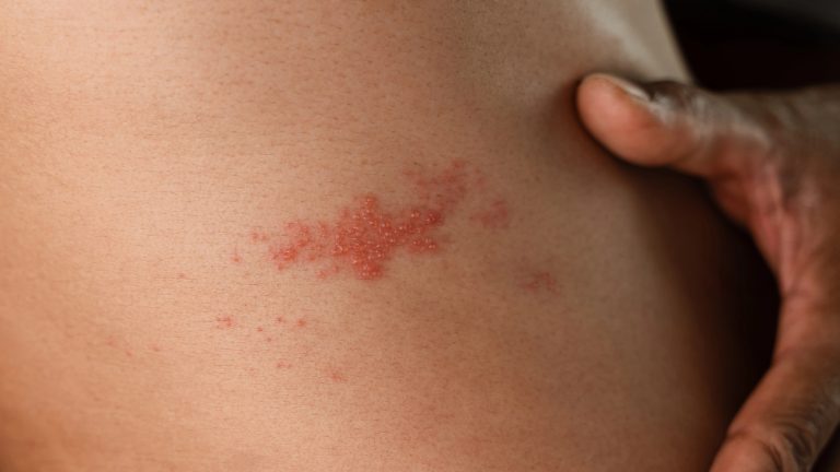 Herpes zóster: síntomas, tratamiento y cómo prevenirlo