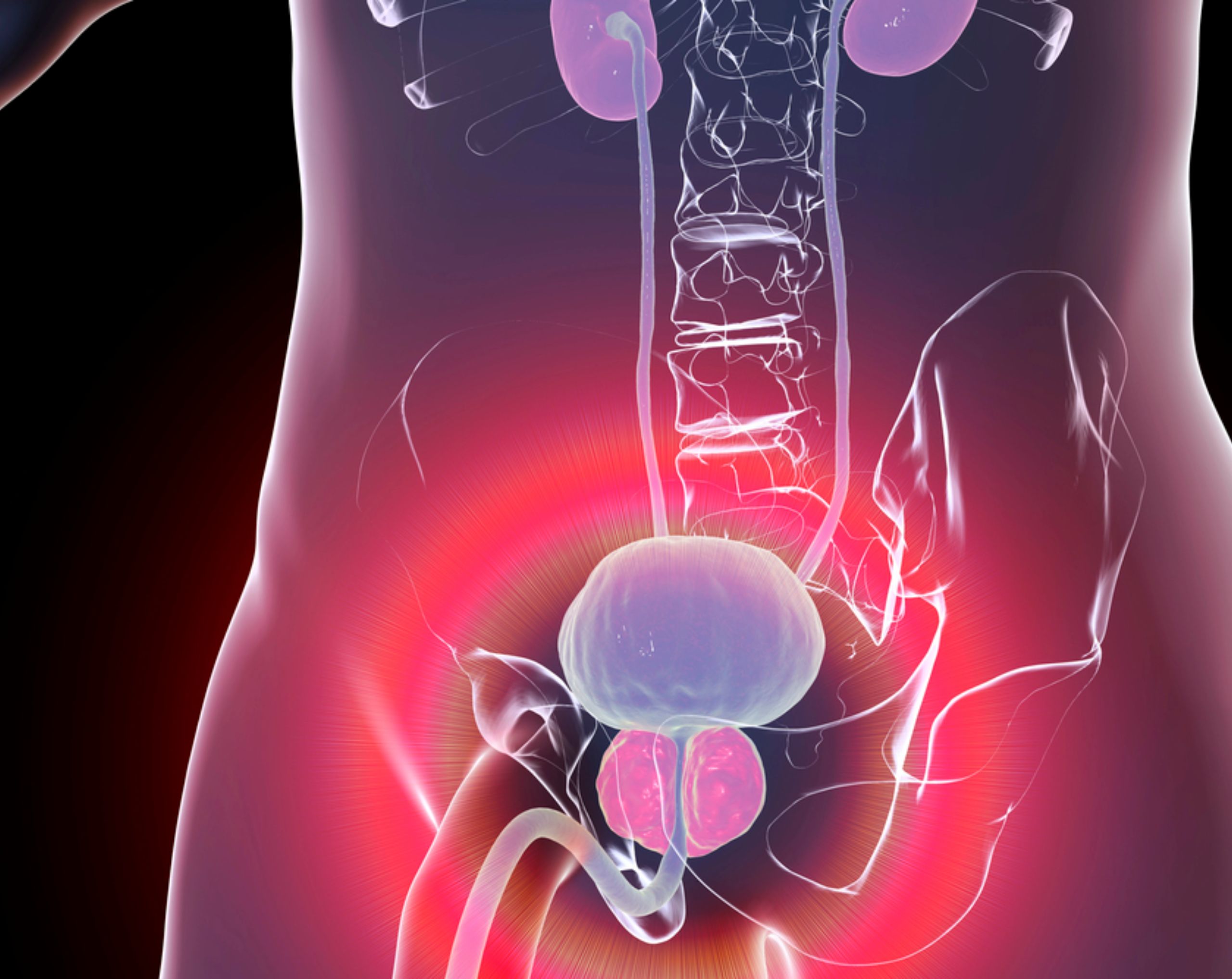 Ilustración 3D de un modelo anatómico del aparato urinario masculino que muestra la hiperplasia prostática benigna.