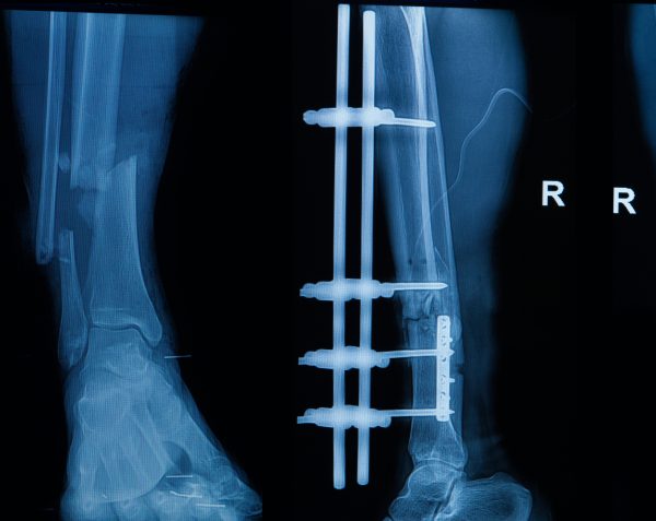 6 síntomas de una fractura de tibia y peroné