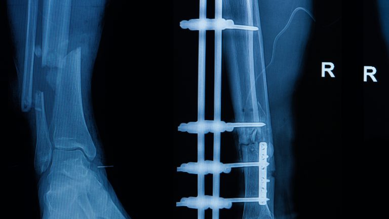 6 síntomas de una fractura de tibia y peroné
