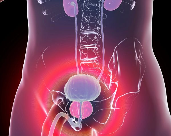 ¿Qué es la hiperplasia prostática benigna?