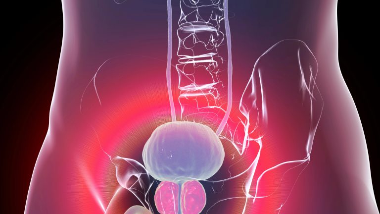 ¿Qué es la hiperplasia prostática benigna?