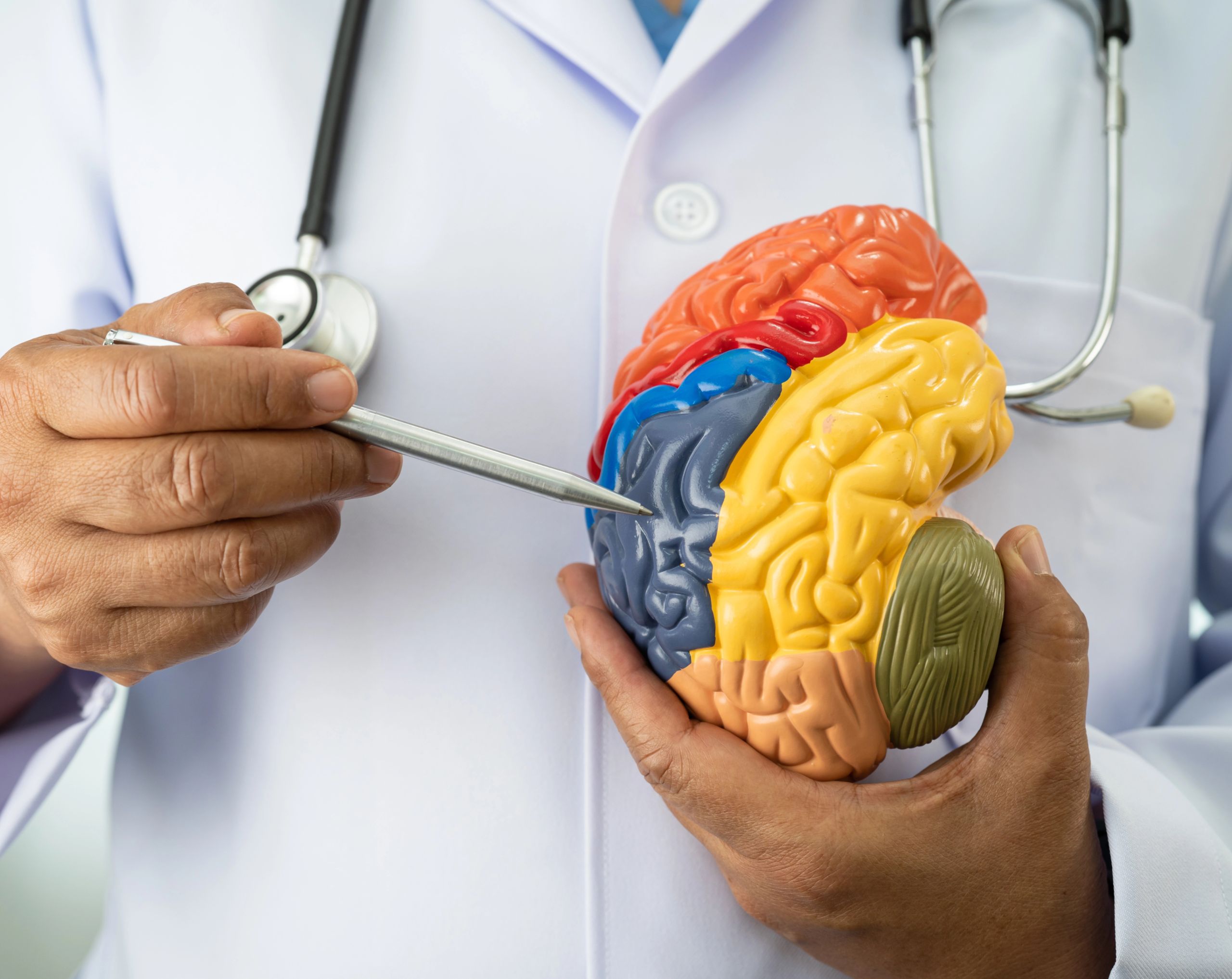 Médico con bata blanca sosteniendo un modelo anatómico del cerebro mientras señala las áreas que pueden verse afectadas por la hidrocefalia.