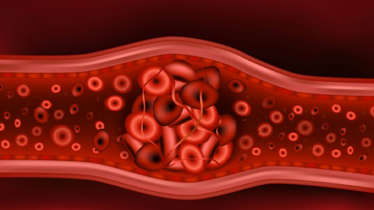Embolia pulmonar: ¿Qué es?