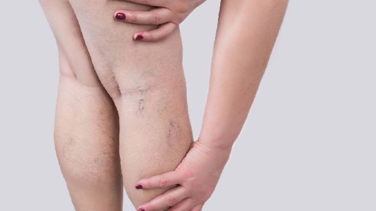 Várices: ¿Cómo prevenirlas?