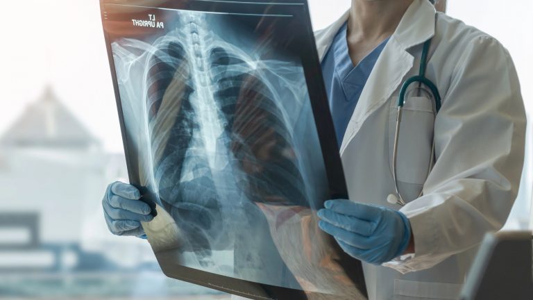 ¿Cómo se contagia la tuberculosis? | Prevención